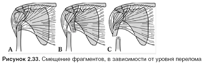 Реферат: Закрытый косой диафизарный перелом левой бедренной кости на границе средней и нижней трети со